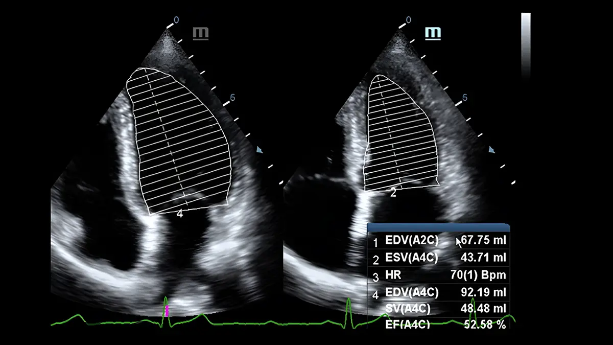 Resultado de un ultrasonido cardiaco