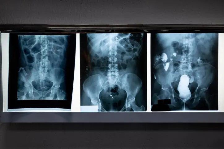 Ventajas cl&iacute;nicas de la detecci&oacute;n dual en rayos X