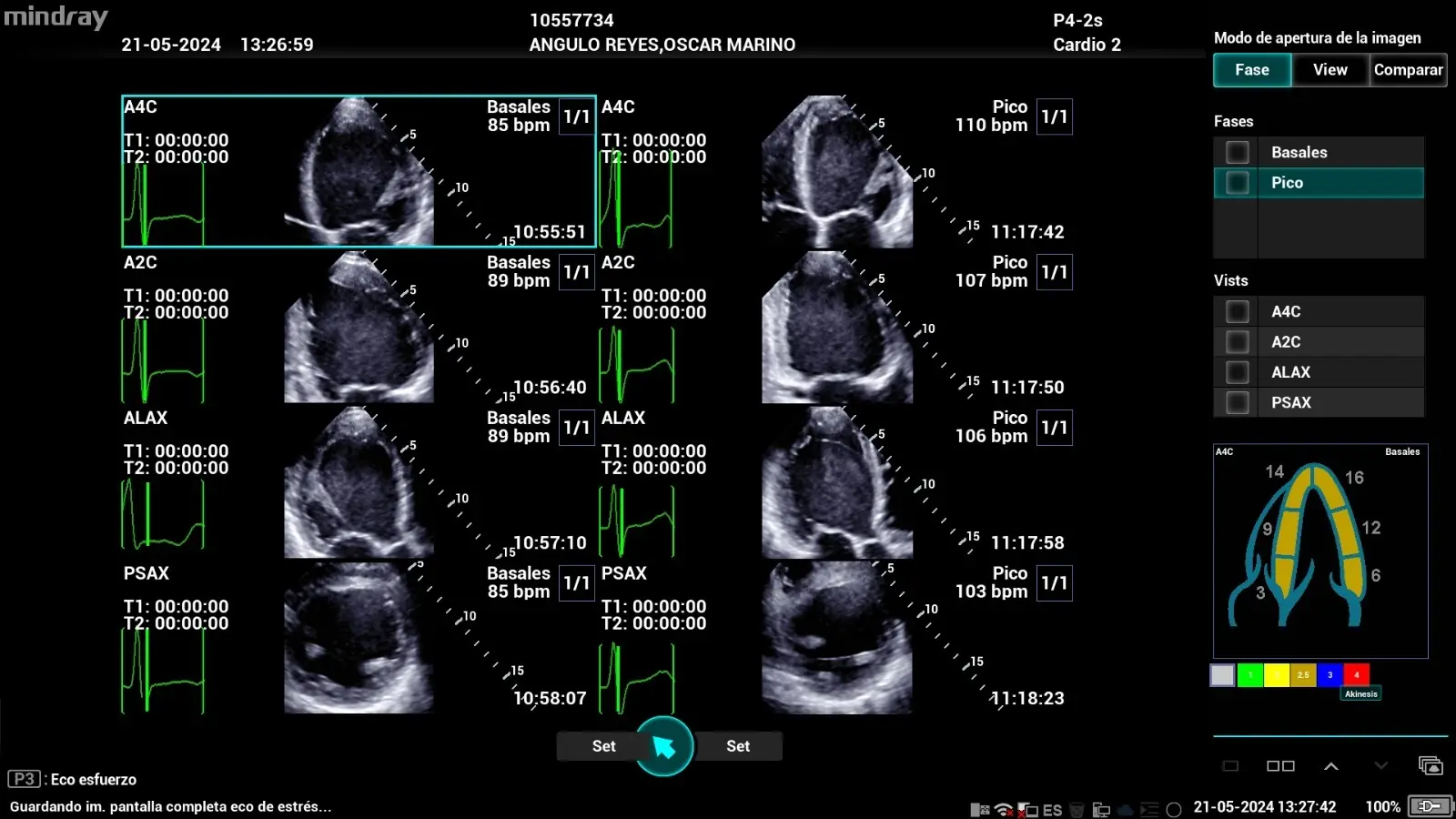 Detección temprana de alteraciones hemodinámicas