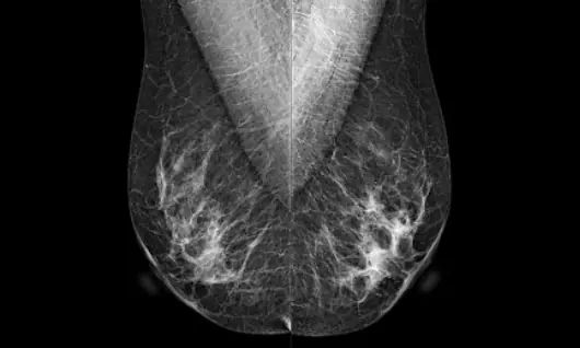 ¿Por qué es clave la resolución espacial en mamografía y cómo lo garantizan los nuevos equipos?
