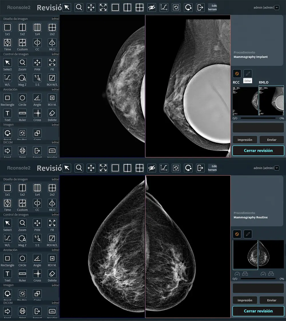 &iquest;Por qu&eacute; las microcalcificaciones exigen mayor precisi&oacute;n?