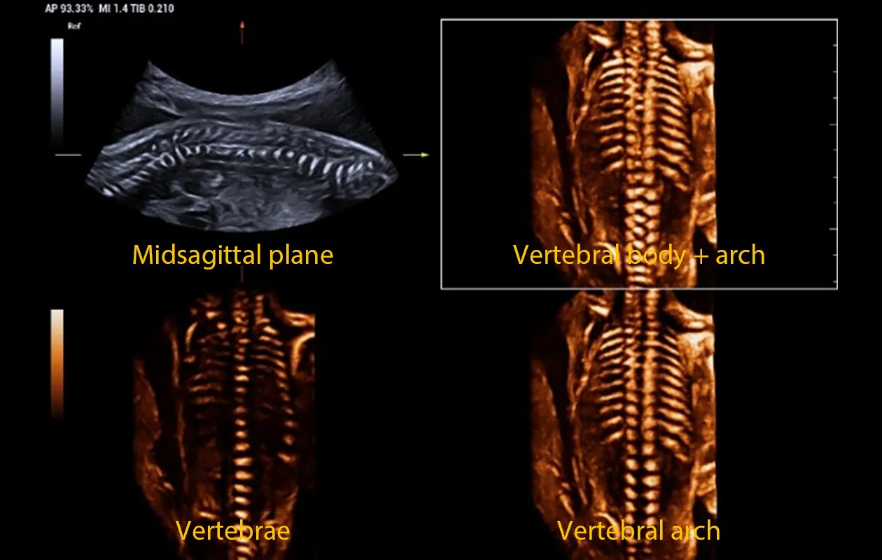 Plano midsagital y visualizaci&oacute;n de la columna vertebral fetal obtenida con Smart planes spine en el Nuewa I10
