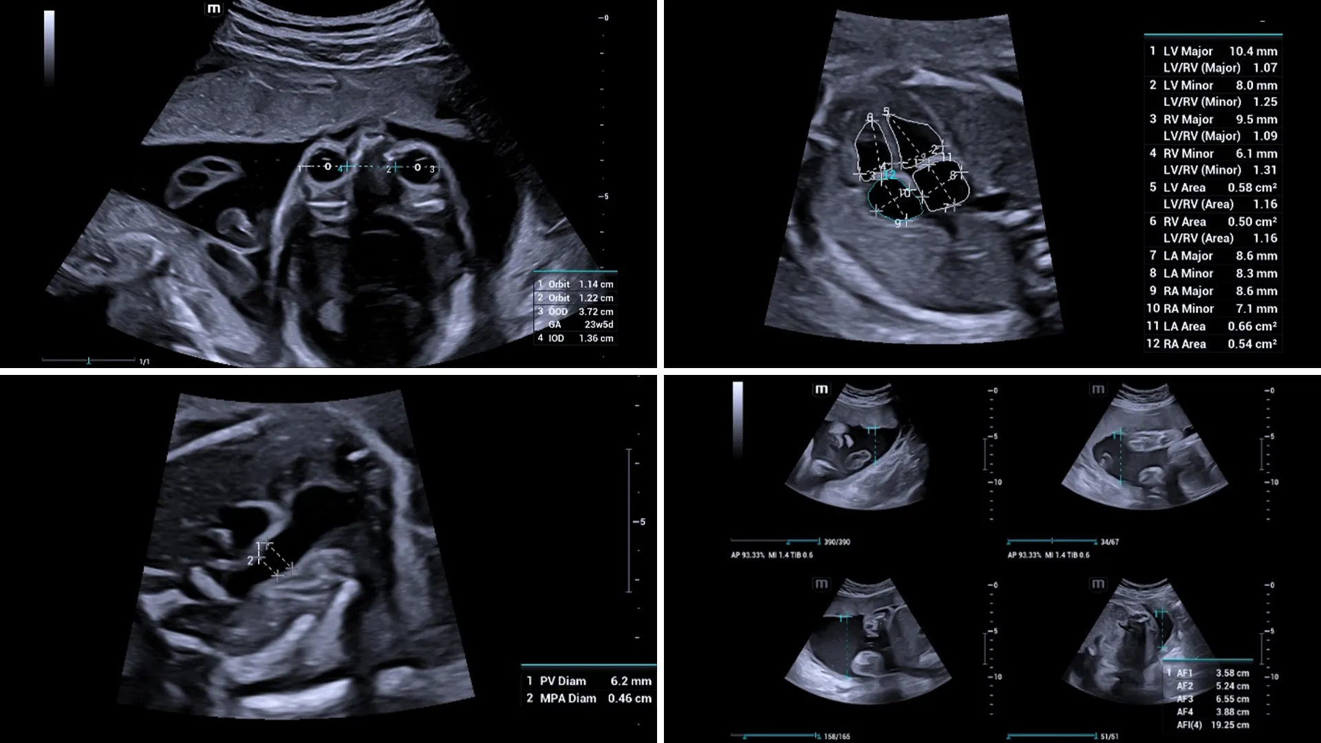 Pantallas de visualizaci&oacute;n de mediciones fetales y ecocardiograf&iacute;a con Smart OB Calc en el ec&oacute;grafo Nuewa I10