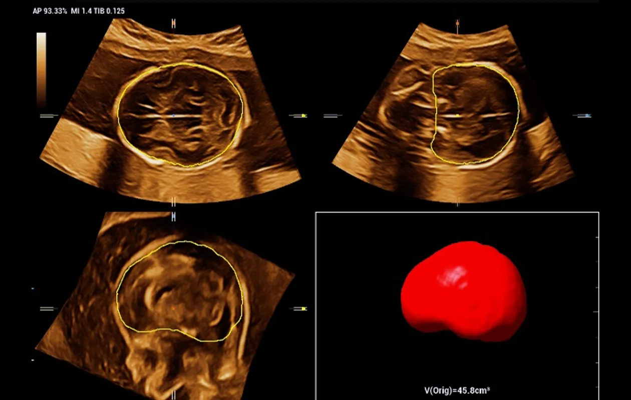 Cuantificaci&oacute;n automatizada del volumen intracraneal fetal mediante Smart ICV en el ec&oacute;grafo Nuewa I10