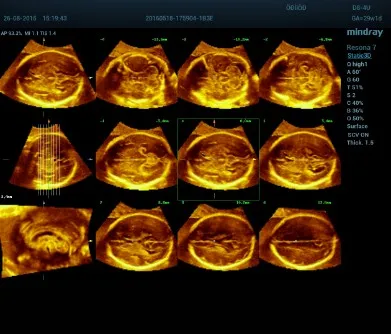 promedco EVALUACIÓN DEL SISTEMA NERVIOSO FETAL POR ULTRASONIDO
