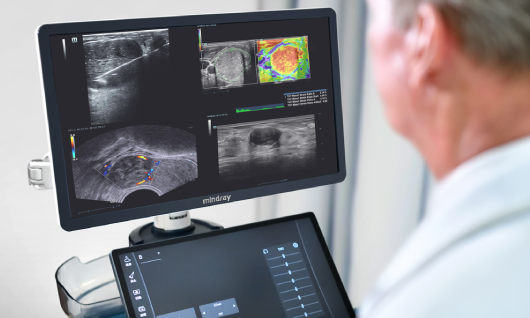 El papel del ultrasonido en el monitoreo oncológico de un paciente ya diagnosticado